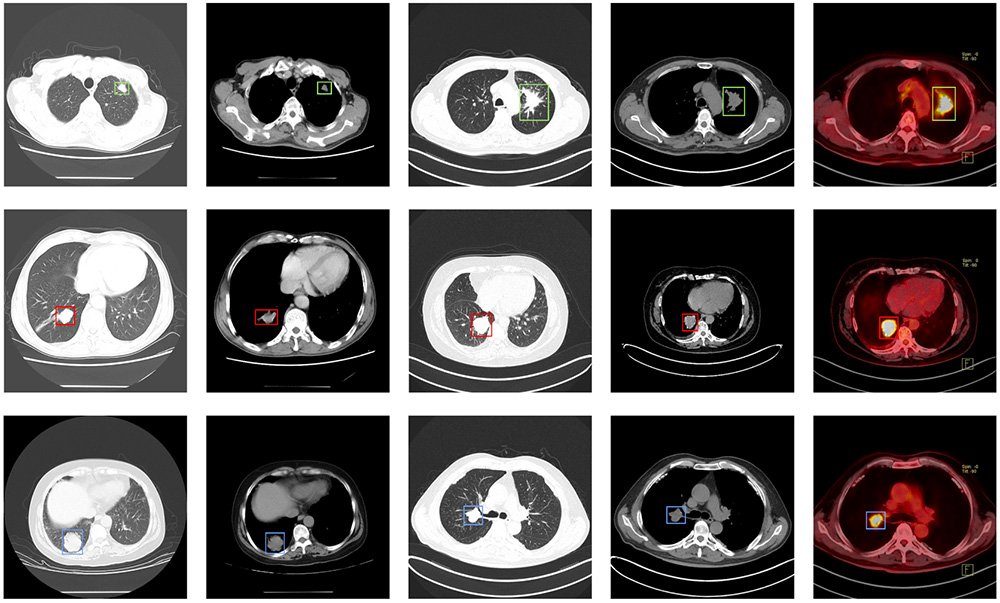 Lung-PET-CT-Dx